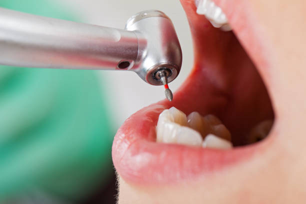 Best Broken or Cracked Tooth Emergency Dentist in USA